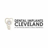 dentalimplantscleveland